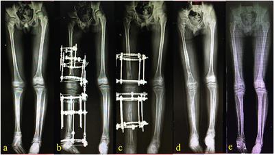 Case report: Single-session double-Ilizarov lengthening technique in the treatment of a child with congenital fibular deficiency